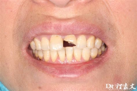 从开始到现在之断牙粘接Ⅱ-牙之守护者的博客-KQ88口腔博客