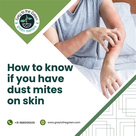 how to know if you have dust mites on skin