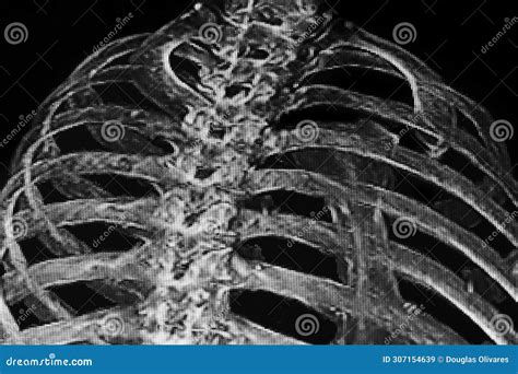 Chest CAT- SCAN of Rib Fracture. Medical Themes Stock Image - Image of doctor, torso: 307154639
