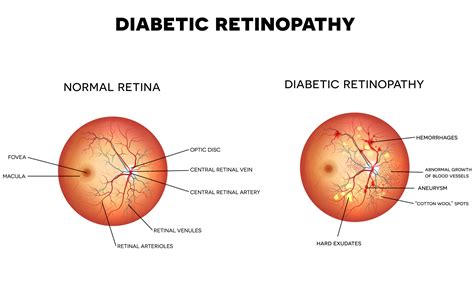 Diabetic Retinopathy - Symptoms, Causes & Treatment | Lions Eye Institute
