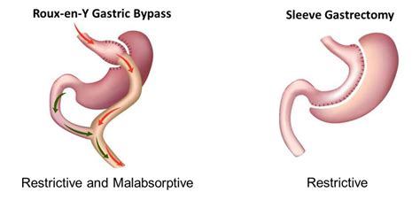 Sleeve Gastrectomy Vs Gastric Bypass