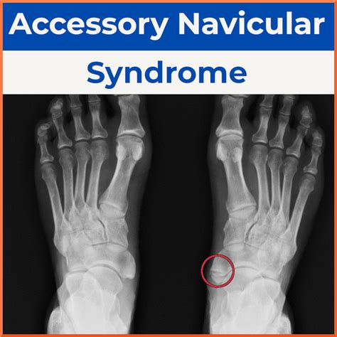 Accessory Navicular Syndrome - Sports Medicine Review