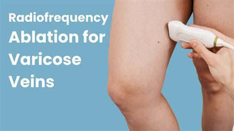 How Radiofrequency Ablation Treats Varicose Veins