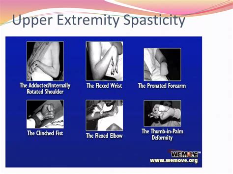 Image result for Spasticity Explained