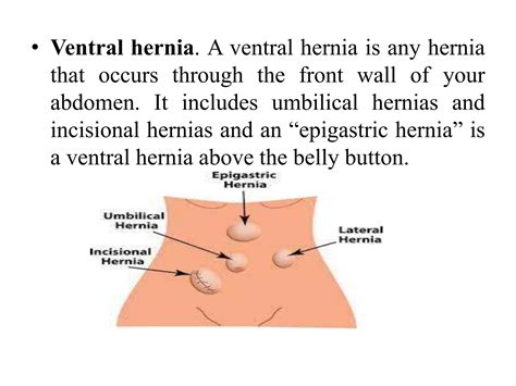 hernia.pptx