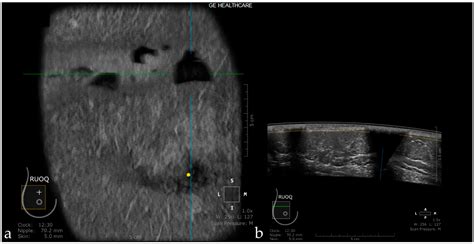 Pros and Cons for Automated Breast Ultrasound (ABUS): A Narrative Review