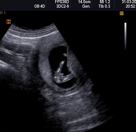 懷孕 12 週性別 – Hamsiaxi