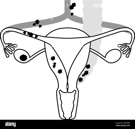 Diagrammatic illustration of stage III ovarian cancer, anatomy of the uterus and ovaries ...