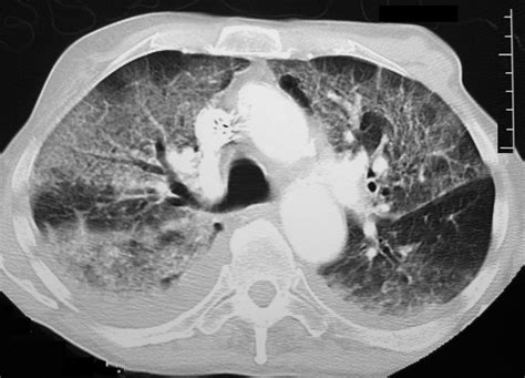 Lungs Fx Ground Glass Opacity Crazy Paving Bilateral Pleural effusions Mosaic Attenuation Dx ...