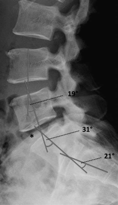 A reliable measurement for identifying a lumbosacral transitional ...