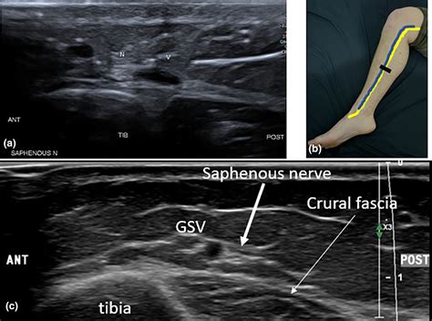 Saphenous Nerve Block