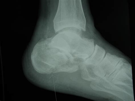 Calcaneal Fracture ORIF - FootEducation
