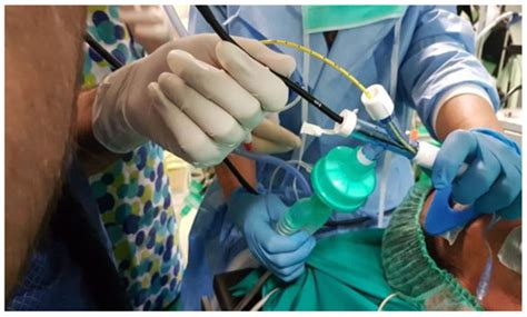 Lung Cryobiopsy for the Diagnosis of Interstitial Lung Diseases: A ...