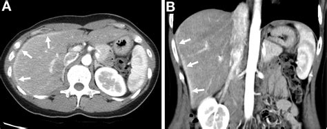 Fitz-Hugh-Curtis Syndrome - Clinical Gastroenterology and Hepatology