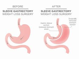 Gastrectomy 的图像结果
