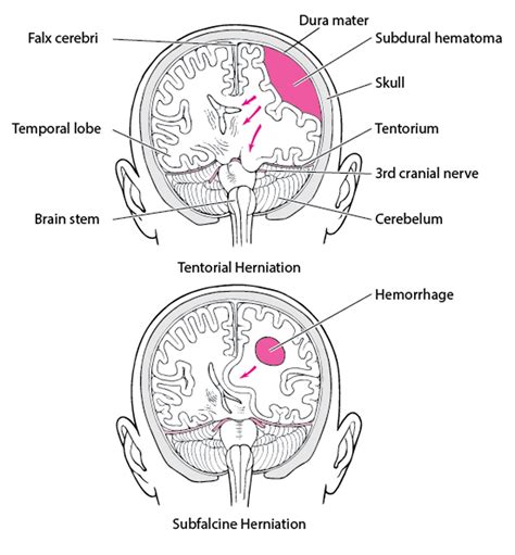 Image:Brain herniation-MSD Manual Professional Edition