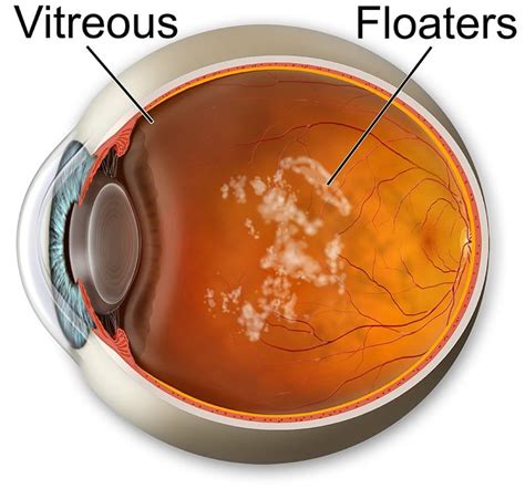 Image result for Eye Floater Types