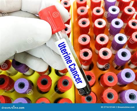Blood Sample for Uterine Cancer Test. Stock Photo - Image of disease, health: 271613144