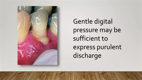 Abscess of periodontium | PPTX