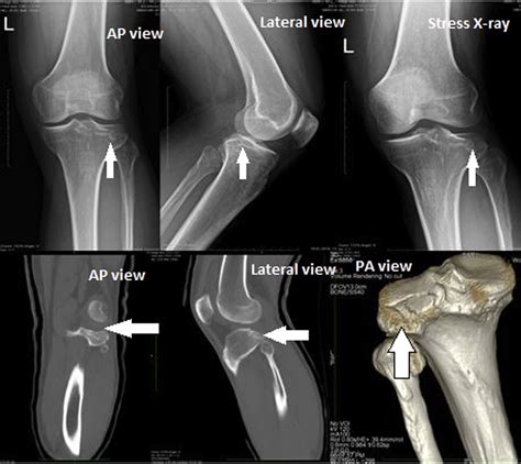 All-Arthroscopic Treatment of Schatzker Type III Lateral Tibial Plateau Fracture Without ...