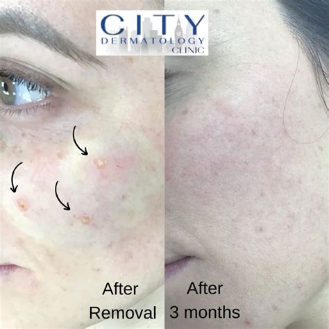 Mole Removal in London from £275 | Same Day Treatment