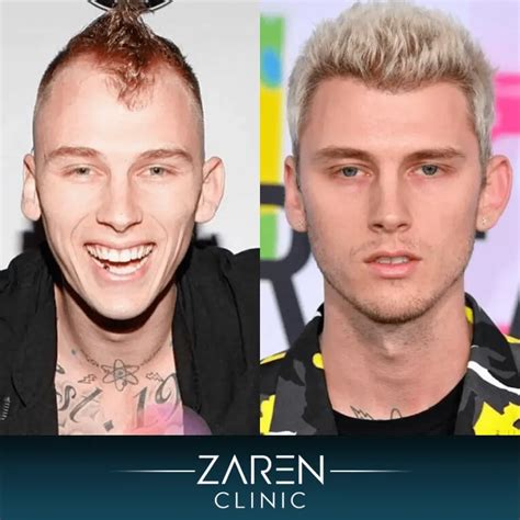 Machine Gun Kelly Hair Transplant - Zaren Health