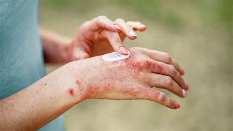 These are the signs that he is… | How to treat hand rashes, How to get ...
