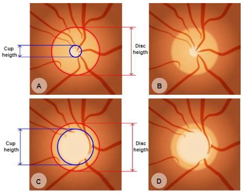 Open Angle Glaucoma Cup To Disc Ratio