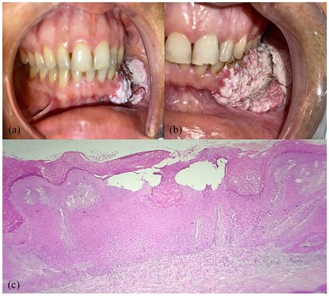 Leukoplakia Buccal Mucosa
