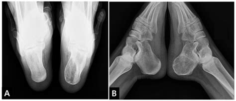 Calcaneus Bone X Ray