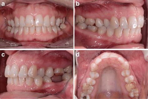 Image result for Crossbite Treatment Options