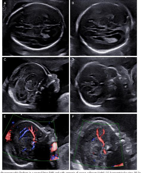 Figure 1 from Clinical outcomes and neurodevelopmental outcome of ...