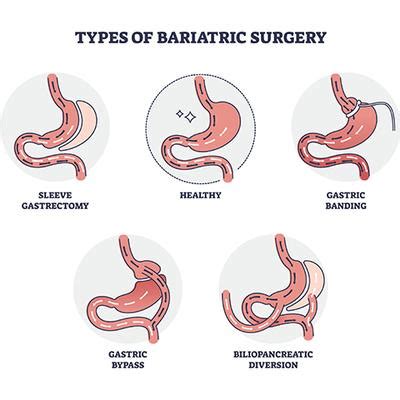 Sleeve vs Bypass vs Balloon for Diabetes: Best Procedure Guide