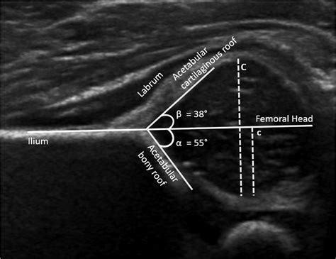 Complications of Closed Reduction of Developmental Dysplasia of the Hip ...