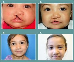 Image result for cleft