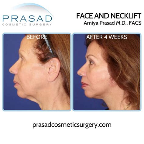 How to Tighten Neck Skin? Surgical and Non-Surgical Options