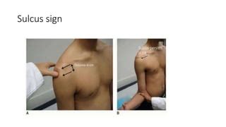 Image result for Sulcus Sign Shoulder
