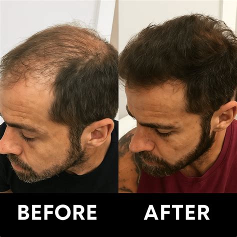 Can Hair Loss Be Reversed