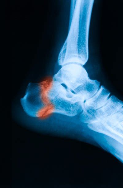 Complications of ORIF Ankle Surgery | LIVESTRONG.COM