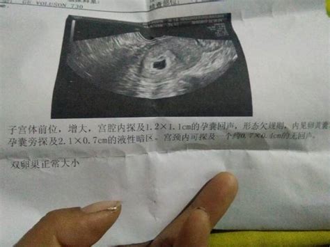 怀孕45天孕囊大小正常值分享，虚弱孕妇平均1.5cm左右 - 名医在线