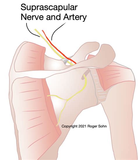 Suprascapular Nerve Compression – Orthocare Health
