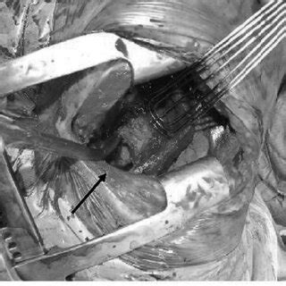 Image result for Exploratory Thoracotomy