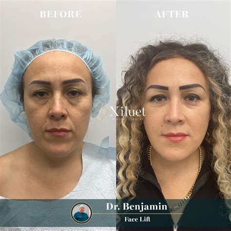 Top-Rated Face Lift Surgery | 10+ Years Experience