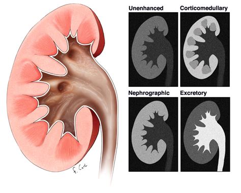 How Not to Miss or Mischaracterize a Renal Cell Carcinoma: Protocols, Pearls, and Pitfalls | AJR