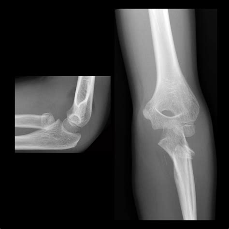 Fractured Elbow Symptoms Broken Elbows In Children And Teenagers: An