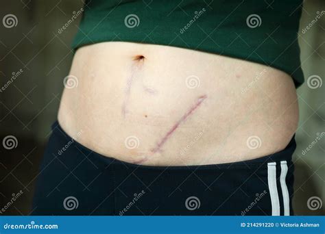 Kidney Donor Scar Location at Hayley Stokes blog