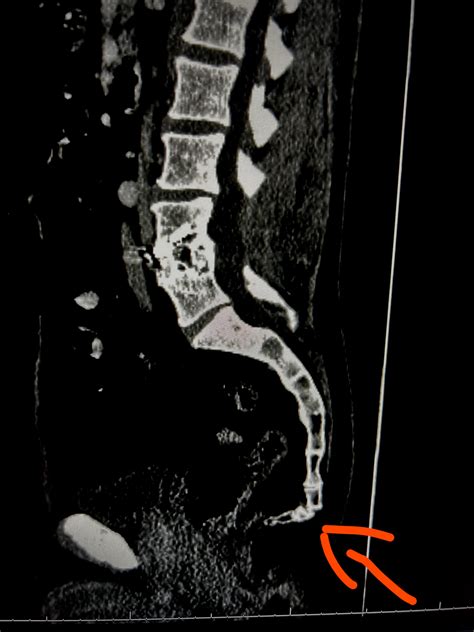 Tailbone / Coccyx Broken?? : r/medical