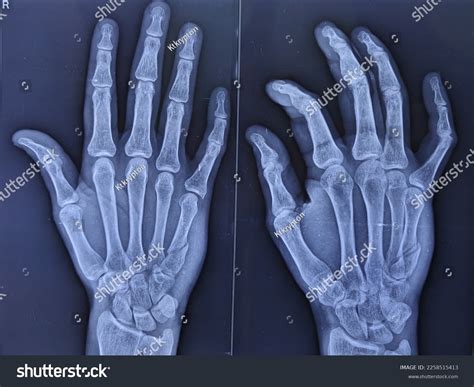Fracture Fifth Metacarpal Bone Right Hand Stock Photo 2258515413 ...