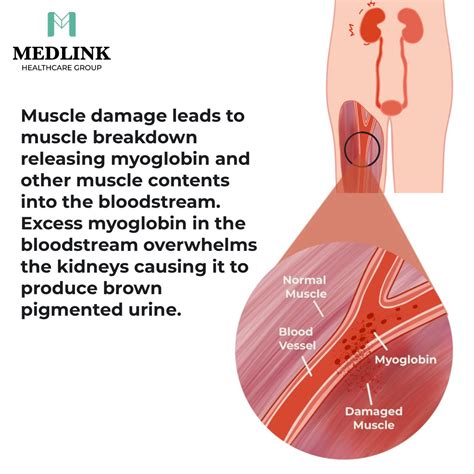 Understanding Rhabdomyolysis: Causes, Symptoms, Prevention, and Treatment | Medlink Healthcare Group