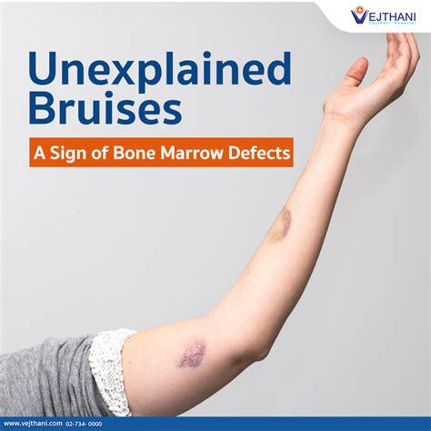 Bone Marrow Defect at Angel Stoltz blog